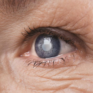 Eye Clouded by Cataract