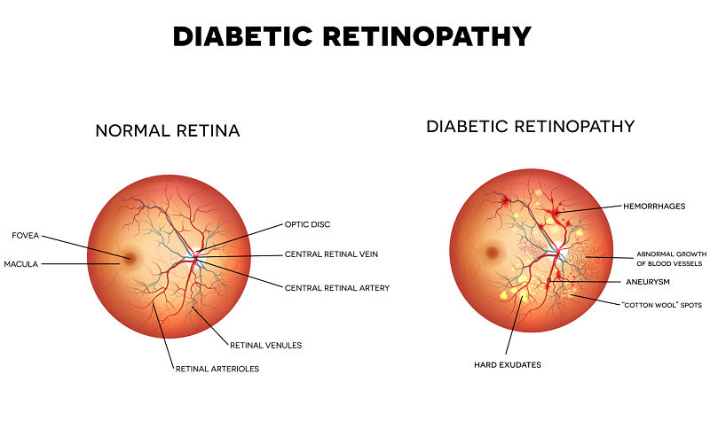 Normal Retina Vs Diabetic Retinopathy Diagram
